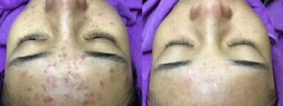 抗皱紧肤延缓衰老的方法有哪些？紧肤抗皱首选悦蕾冰泉面膜